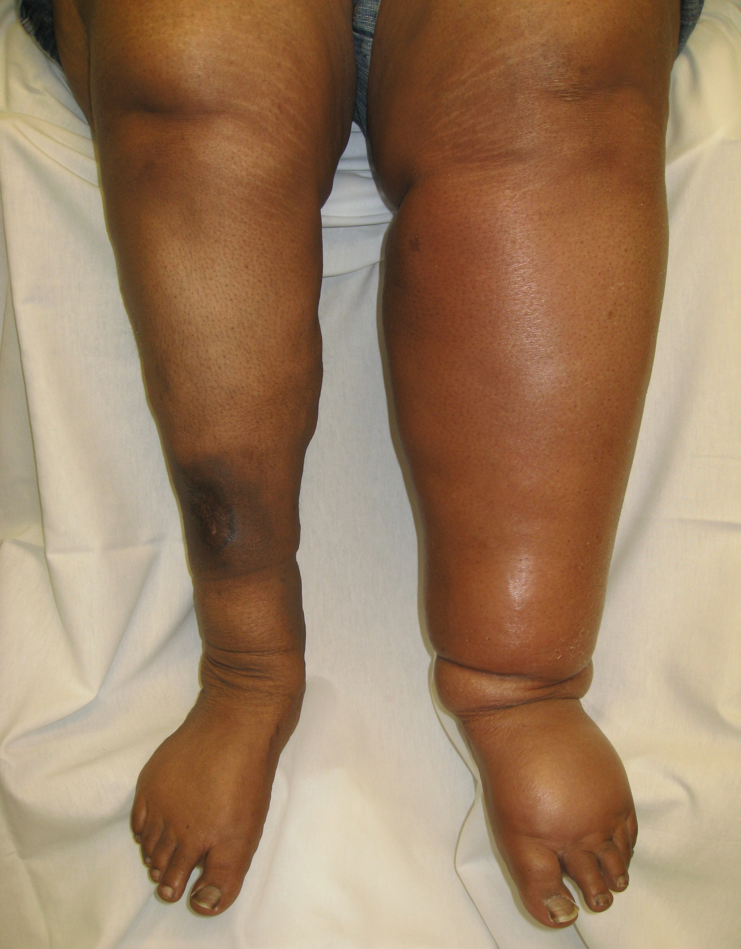 acute left leg DVT, post thrombotic syndrome right leg