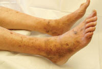 Posthrombotic pigmentation