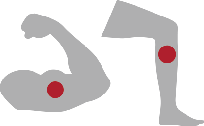 dvt-arm-leg DVT in arm or leg