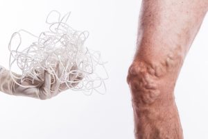 human leg with blocked veins, thrombosis, phlebitis, and standing on a white background, with depth of field Photo