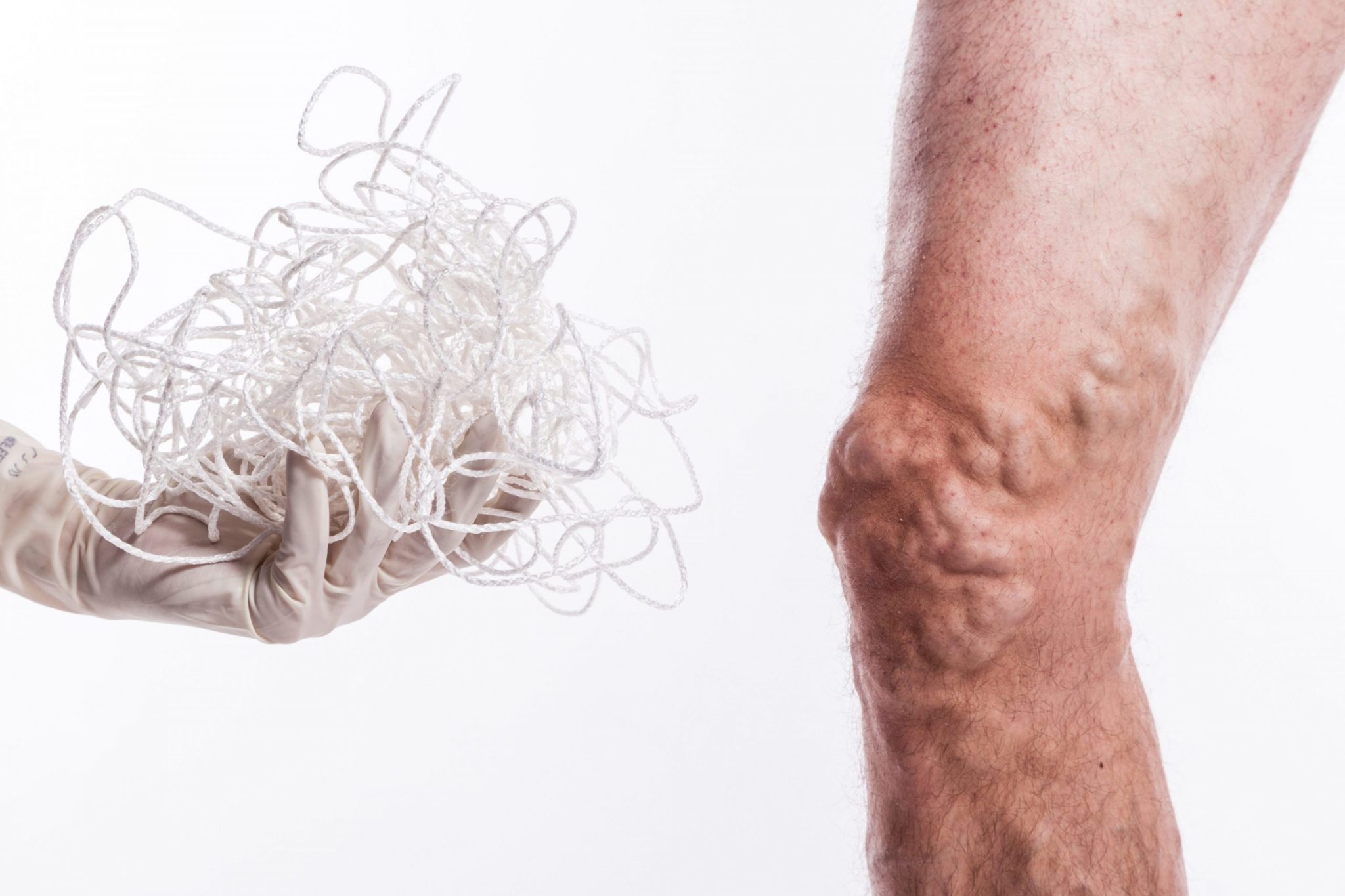 crema i geluri împotriva varicozei perna ortopedica pentru picior varicoza