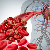 Thrombosis illustration