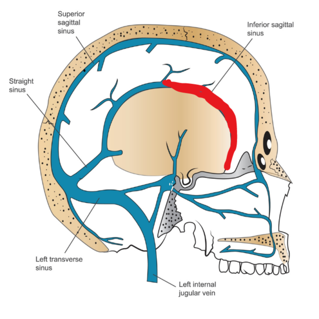 drawing of human brain and the sinus veins with CVST thrombosis