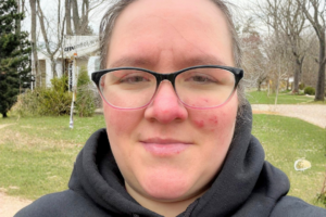 Melissa Jonio, a saddle pulmonary embolism survivor who developed a life-threatening blood clot during recovery from an ankle fracture and underwent an emergency thrombectomy.